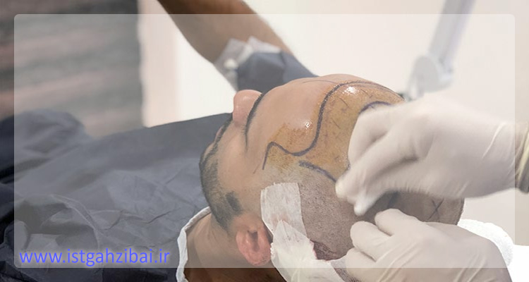کاشت موی super fue
